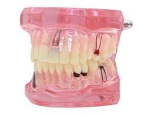 Study Model Molar Large Pink