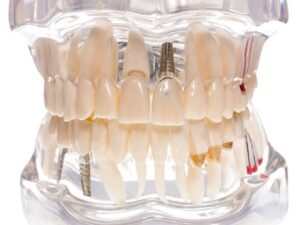Study Model Molar Transparent Large