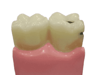 Study Model Molar Large Pink